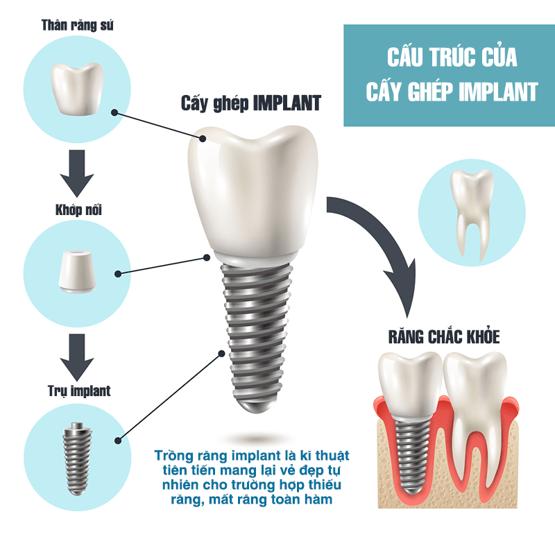 Trồng răng implant được hiểu như thế nào?