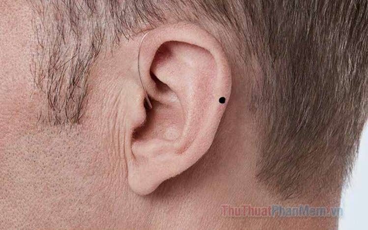 Nốt ruồi ở tai có ý nghĩa gì Tốt hay xấu?